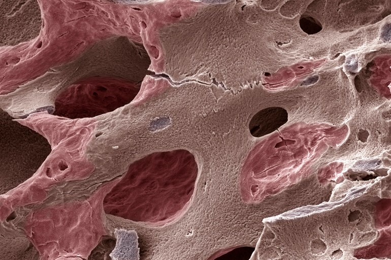 Scanning electron micrograph (SEM) of human bone, osteoporosis - stock photo