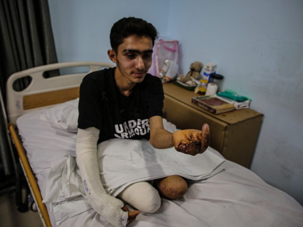 إسرائيل بترت ساقيه.. “الغلبان” فتى الجمباز يحلم بأطراف صناعية