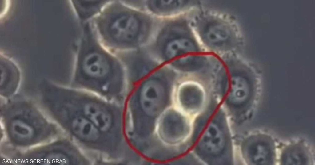 سرطان البنكرياس.. 6 علامات لا يجب تجاهلها أبدا