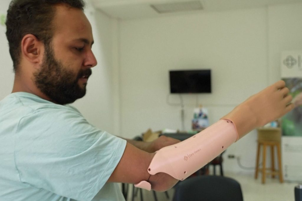 شاهد.. أطراف صناعية بالذكاء الاصطناعي والطباعة ثلاثية الأبعاد في تونس