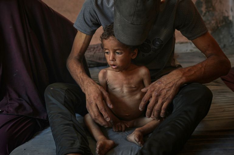 Yazan Abu Ful, a 2-year-old malnourished child, sits with his father for a picture at their home in the Shati refugee camp in Gaza City, Wednesday, July 23, 2025. In Gaza, malnutrition is often worsened by preexisting conditions and compounded by illnesses linked to inadequate health care and poor sanitation, largely the result of the ongoing war. (AP Photo/Jehad Alshrafi)